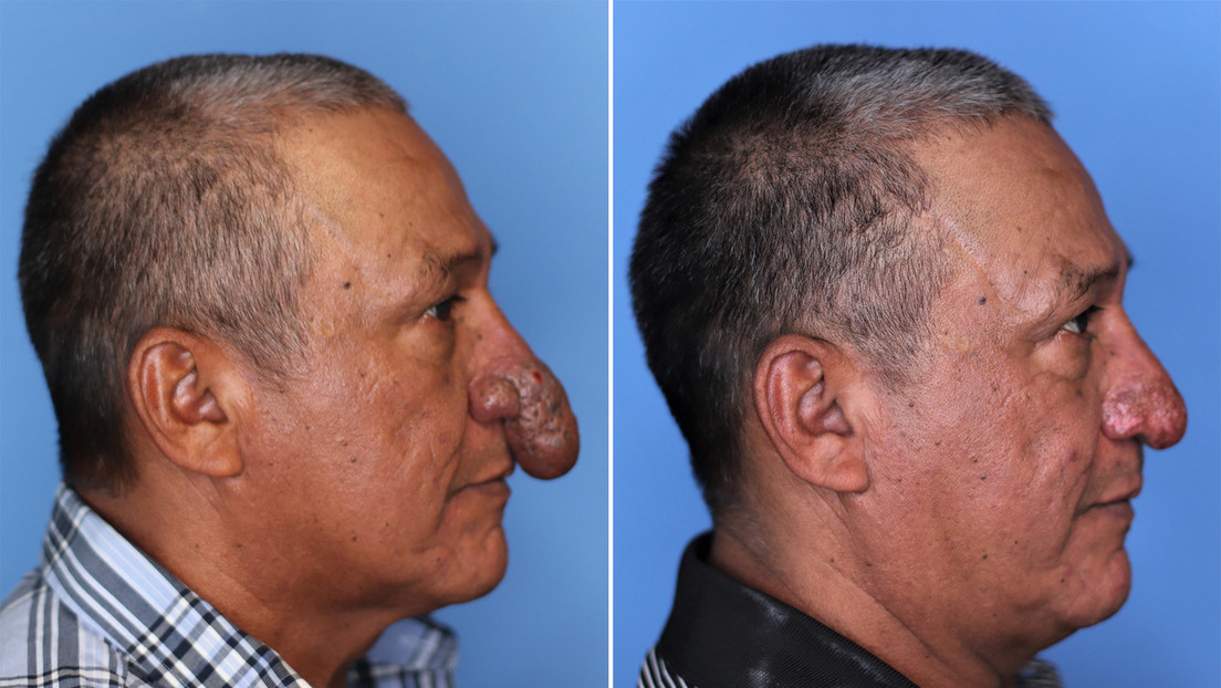 A plastic surgeon reconstructs the face of a worker who was working at home when he noticed he had a rare deformity in his nose
