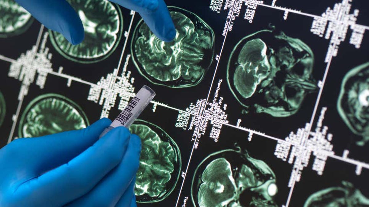 There is a mysterious brain disease in Canada