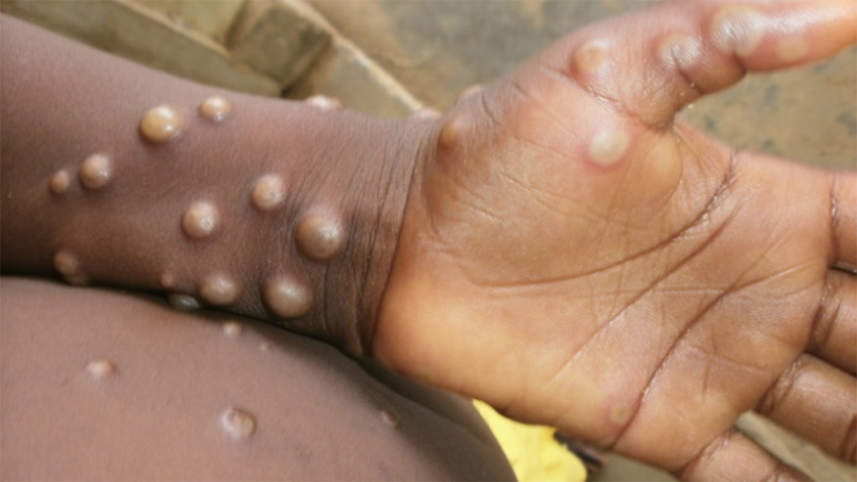 Confirmed case of monkeypox in the UK: what is it?