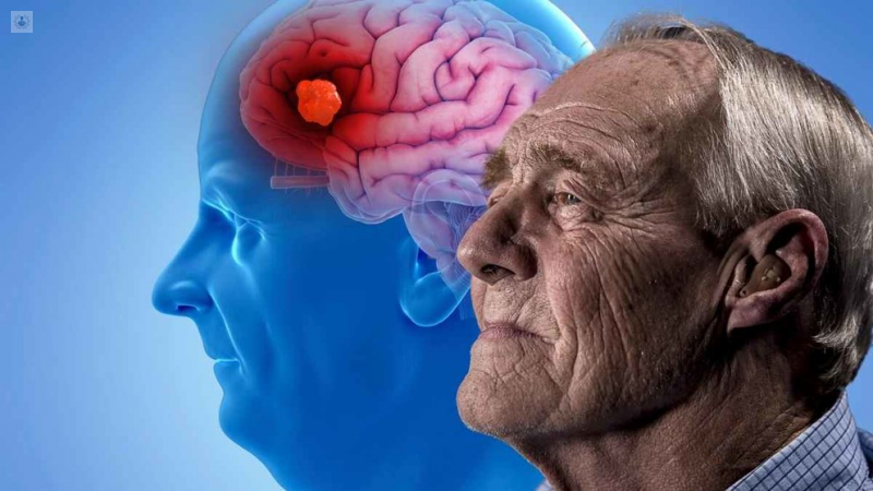 Alzheimer's disease.  (Photo: Senior Doctors)