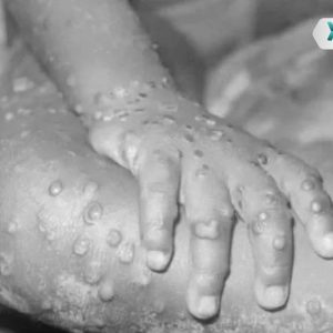What is monkeypox, a disease that is common in Spain, Portugal and the United Kingdom