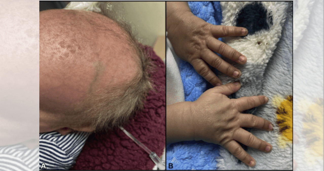 Brittle hair and seizures mask a potentially fatal syndrome in a pediatric patient