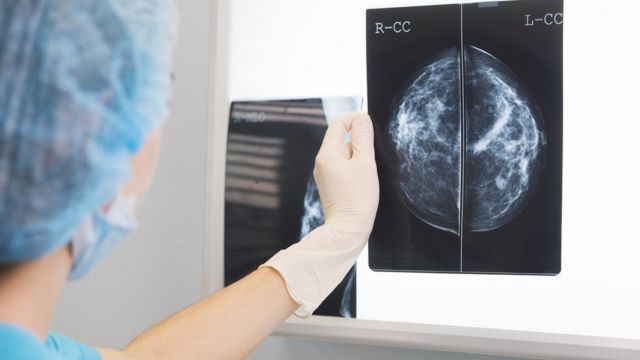 The doctor checks for breast cancer with an x-ray.  (Photo: BBC)