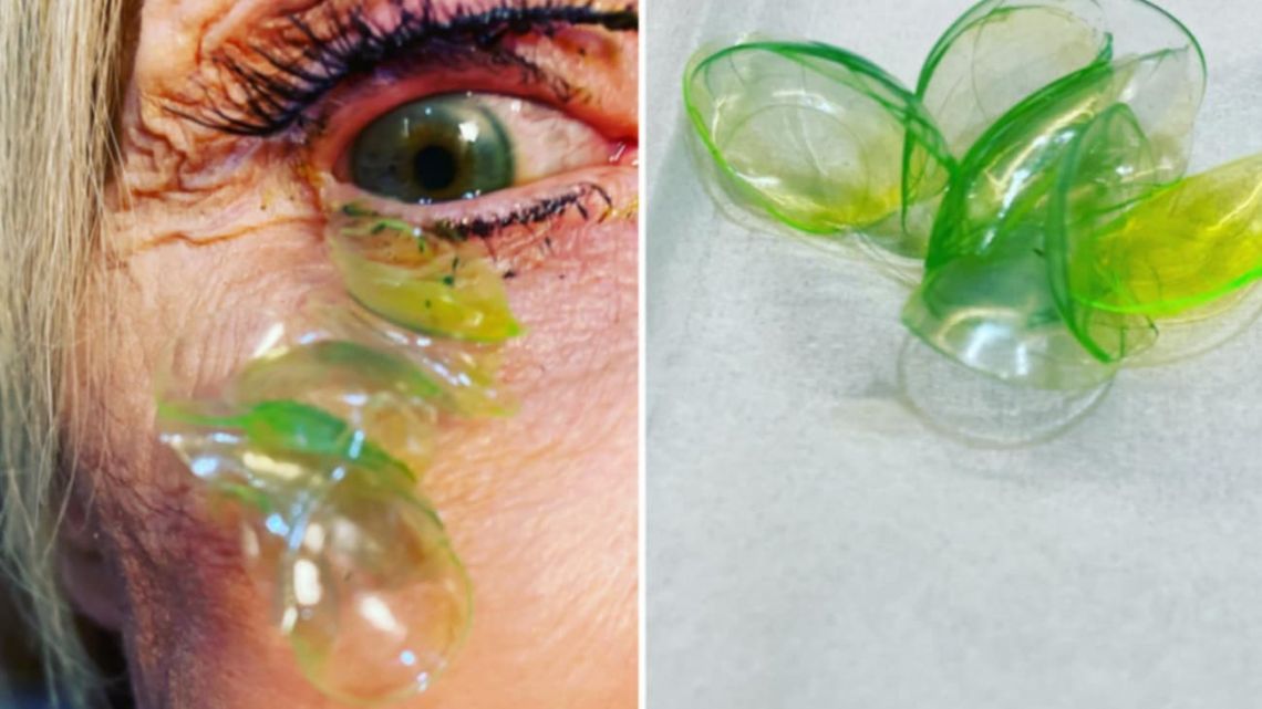 A 70-year-old woman had 23 contact lenses removed from her eyes