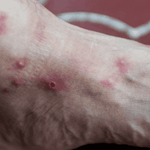 First case of monkeypox confirmed in San Juan |  koyo diary