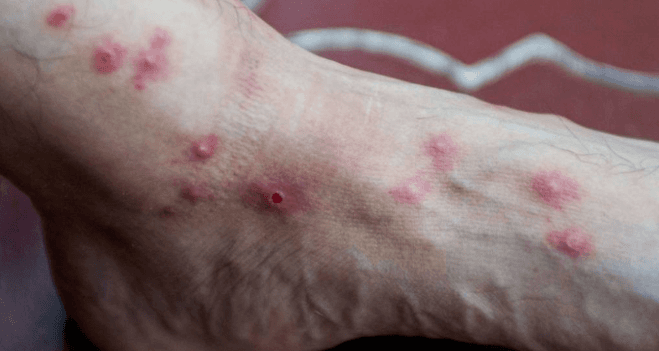 First case of monkeypox confirmed in San Juan |  koyo diary